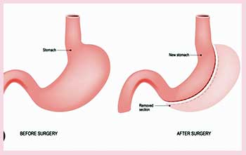 Gastric sleeve surgery